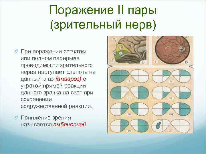 Поражение II пары (зрительный нерв) O При поражении сетчатки или полном перерыве проводимости зрительного