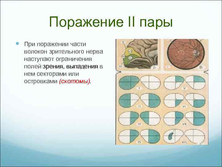Поражение II пары При поражении части волокон зрительного нерва наступают ограничения полей зрения, выпадения