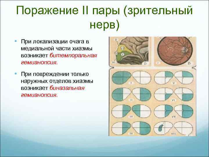 Поражение II пары (зрительный нерв) • При локализации очага в медиальной части хиазмы возникает