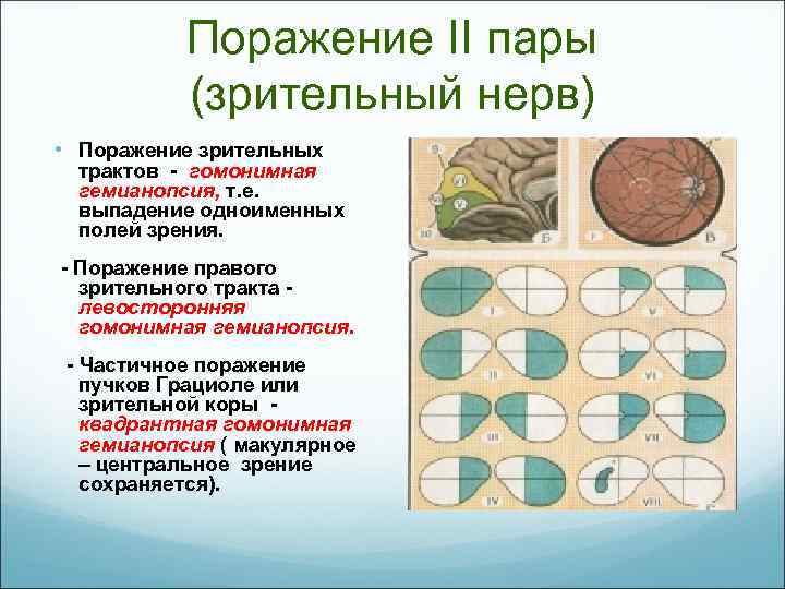 Поражение II пары (зрительный нерв) • Поражение зрительных трактов - гомонимная гемианопсия, т. е.