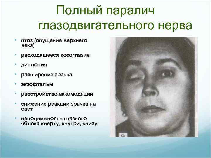 Полный паралич глазодвигательного нерва • птоз (опущение верхнего века) • расходящееся косоглазие • диплопия