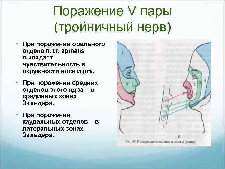 Поражение V пары (тройничный нерв) • При поражении орального отдела n. tr. spinalis выпадает