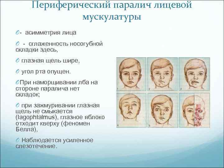 Периферический паралич лицевой мускулатуры O асимметрия лица O сглаженность носогубной складки здесь, O глазная