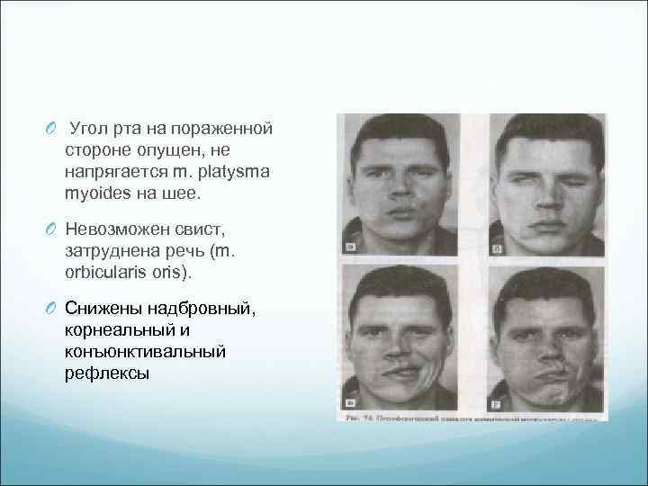 O Угол рта на пораженной стороне опущен, не напрягается m. platysma myoides на шее.