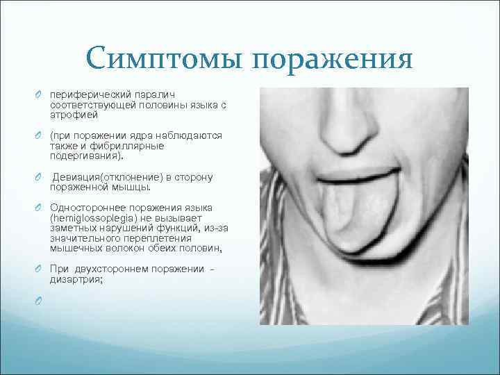 Симптомы поражения O периферический паралич соответствующей половины языка с атрофией O (при поражении ядра