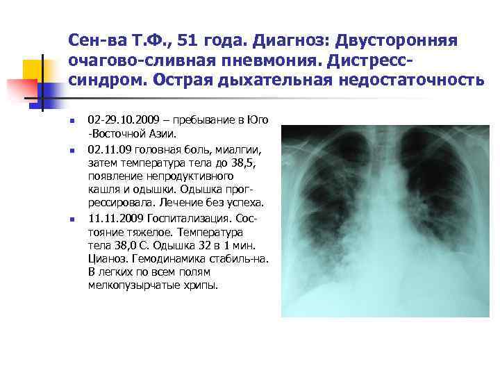 Сен-ва Т. Ф. , 51 года. Диагноз: Двусторонняя очагово-сливная пневмония. Дистресссиндром. Острая дыхательная недостаточность