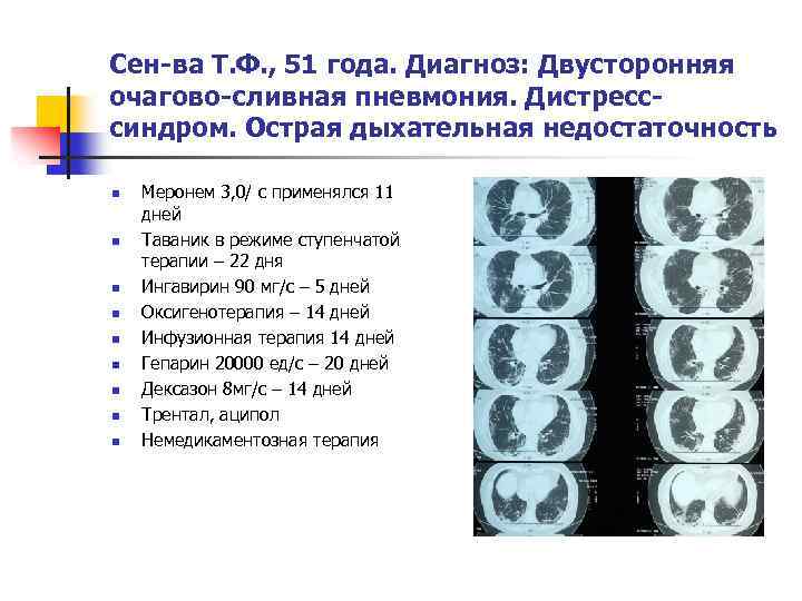 Сен-ва Т. Ф. , 51 года. Диагноз: Двусторонняя очагово-сливная пневмония. Дистресссиндром. Острая дыхательная недостаточность