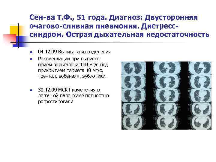 Сен-ва Т. Ф. , 51 года. Диагноз: Двусторонняя очагово-сливная пневмония. Дистресссиндром. Острая дыхательная недостаточность