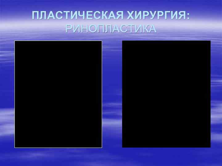 ПЛАСТИЧЕСКАЯ ХИРУРГИЯ: РИНОПЛАСТИКА 