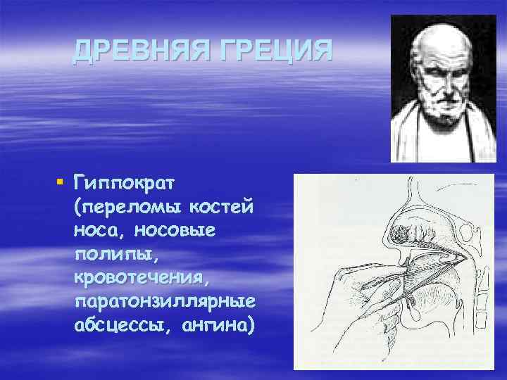 ДРЕВНЯЯ ГРЕЦИЯ § Гиппократ (переломы костей носа, носовые полипы, кровотечения, паратонзиллярные абсцессы, ангина) 