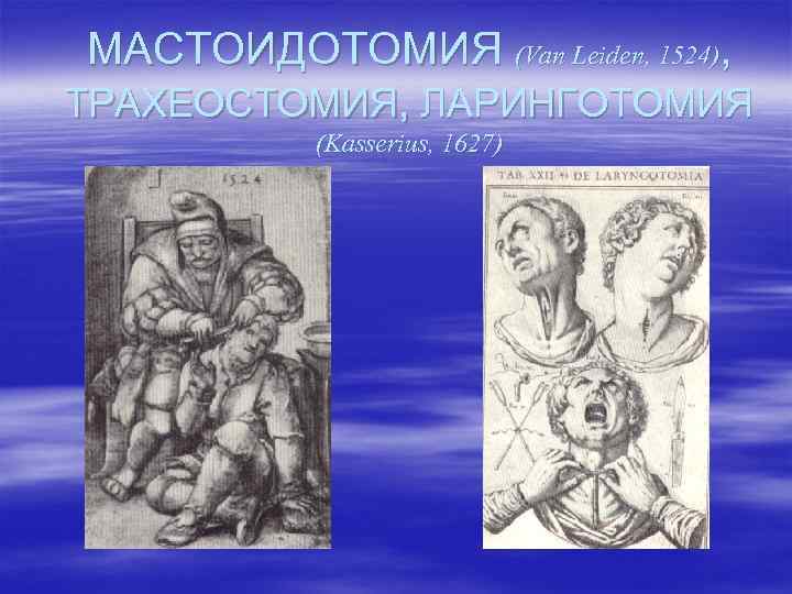 МАСТОИДОТОМИЯ (Van Leiden, 1524), ТРАХЕОСТОМИЯ, ЛАРИНГОТОМИЯ (Kasserius, 1627) 