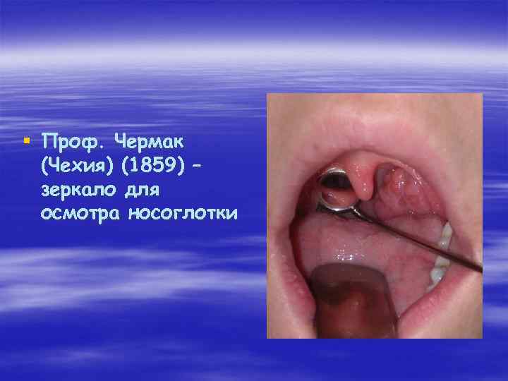 § Проф. Чермак (Чехия) (1859) – зеркало для осмотра носоглотки 