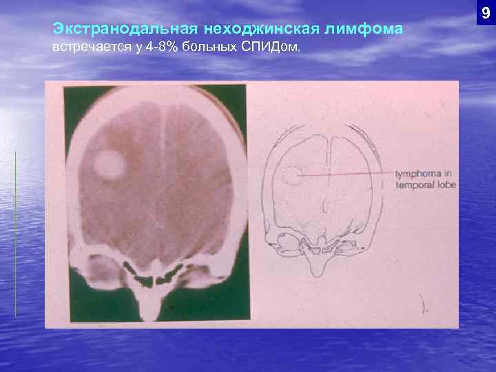 Экстранодальная неходжинская лимфома встречается у 4 -8% больных СПИДом. 9 