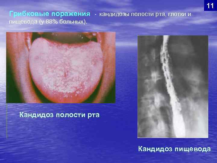 Грибковые поражения 11 - кандидозы полости рта, глотки и пищевода (у 88% больных). Кандидоз