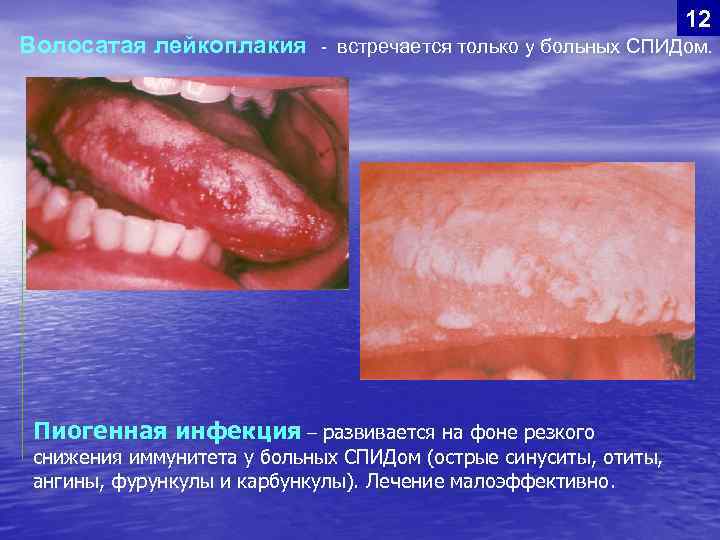 Волосатая лейкоплакия 12 - встречается только у больных СПИДом. Пиогенная инфекция – развивается на