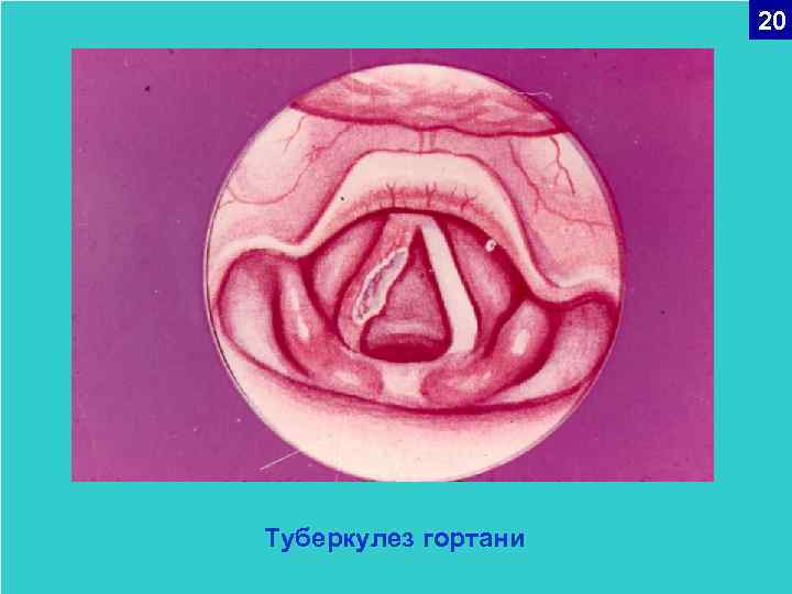 20 Туберкулез гортани 