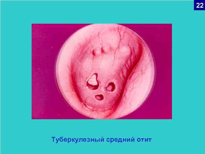 22 Туберкулезный средний отит 