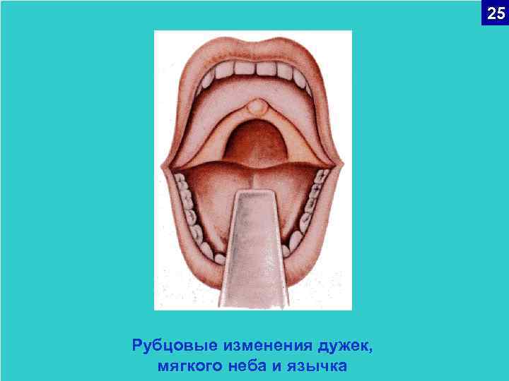 25 Рубцовые изменения дужек, мягкого неба и язычка 