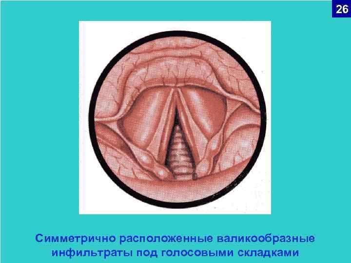 26 Симметрично расположенные валикообразные инфильтраты под голосовыми складками 