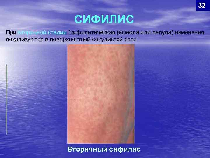32 СИФИЛИС При вторичной стадии (сифилитическая розеола или папула) изменения локализуются в поверхностной сосудистой