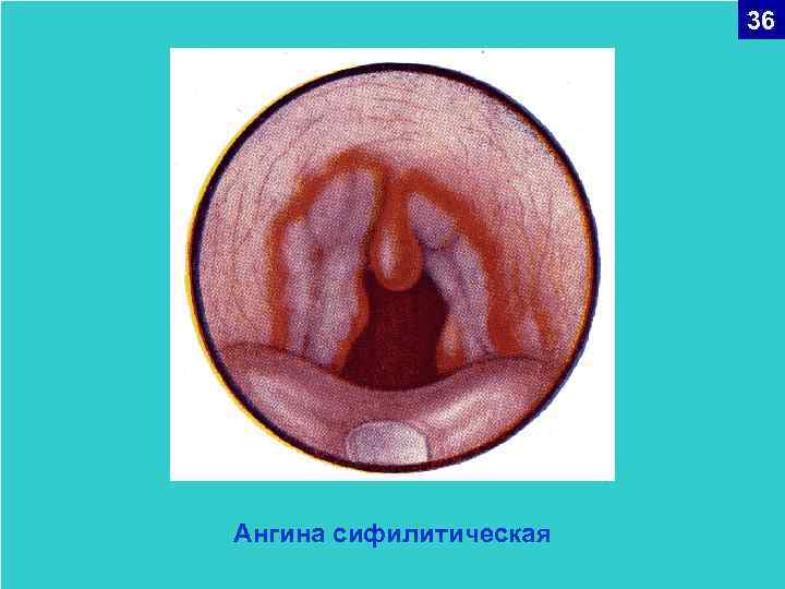 36 Ангина сифилитическая 
