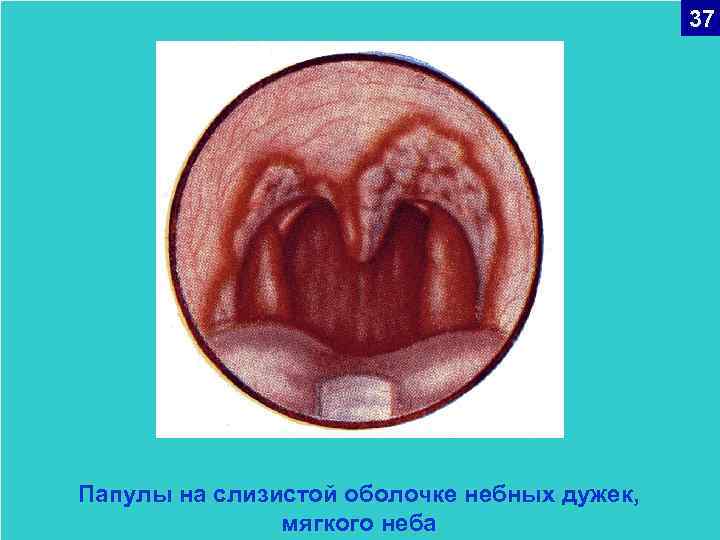 37 Папулы на слизистой оболочке небных дужек, мягкого неба 