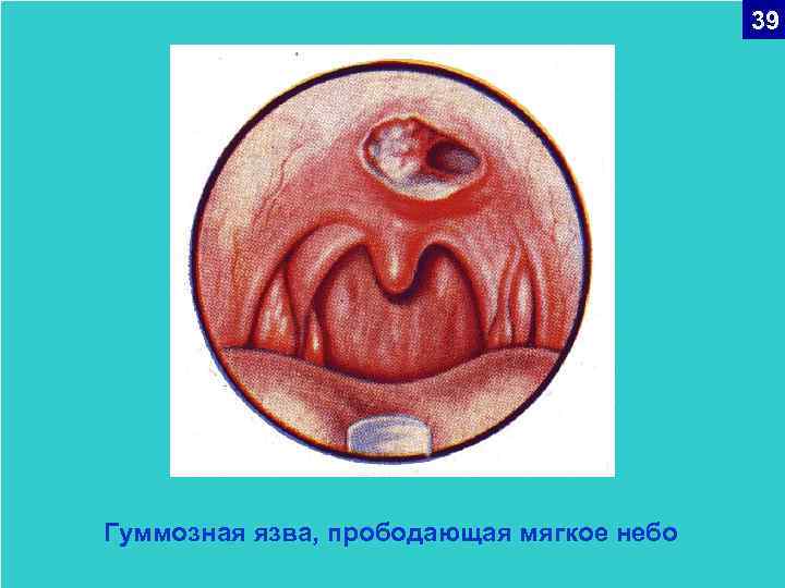 39 Гуммозная язва, прободающая мягкое небо 