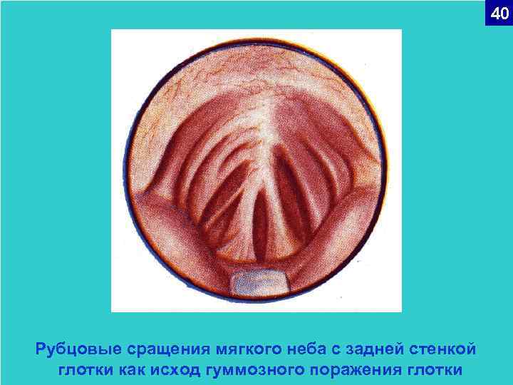 40 Рубцовые сращения мягкого неба с задней стенкой глотки как исход гуммозного поражения глотки