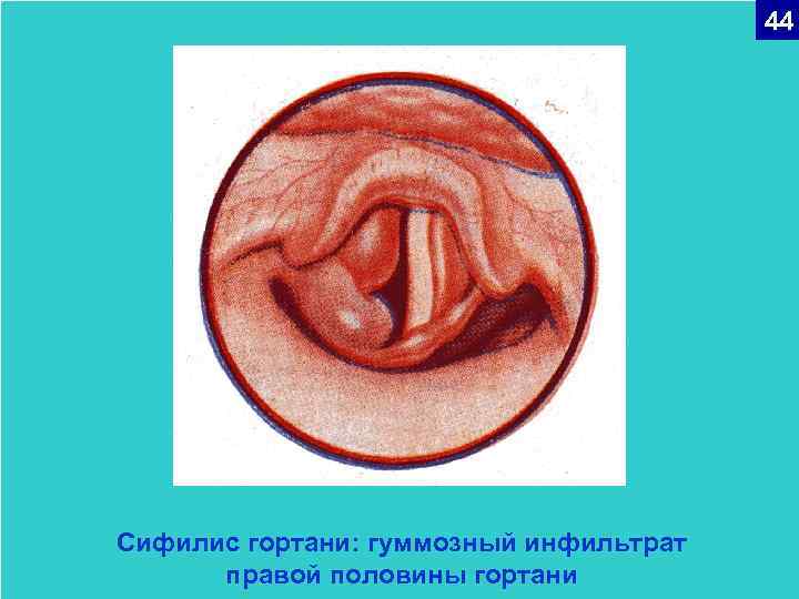44 Сифилис гортани: гуммозный инфильтрат правой половины гортани 