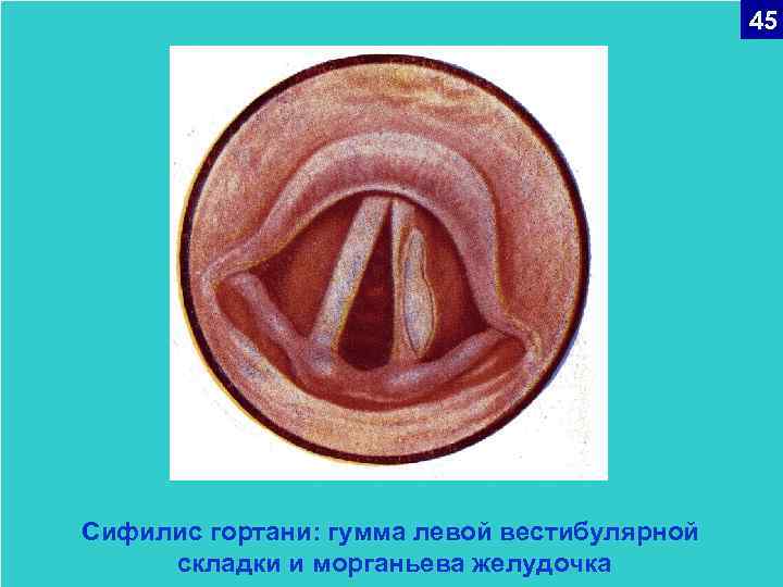 45 Сифилис гортани: гумма левой вестибулярной складки и морганьева желудочка 