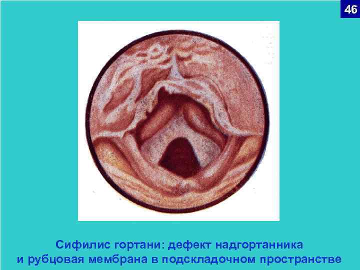 46 Сифилис гортани: дефект надгортанника и рубцовая мембрана в подскладочном пространстве 