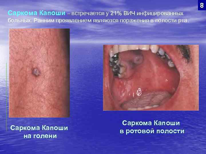 Саркома Капоши – встречается у 21% ВИЧ инфицированных больных. Ранним проявлением являются поражения в