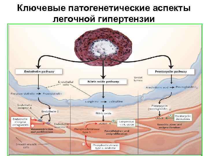 Ключевые патогенетические аспекты легочной гипертензии 