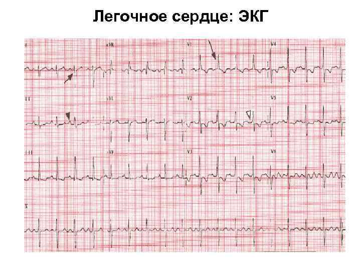 Легочное сердце: ЭКГ 