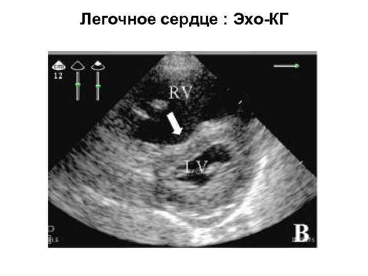 Легочное сердце : Эхо-КГ 