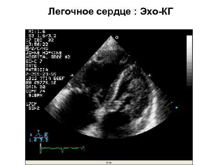 Легочное сердце : Эхо-КГ 