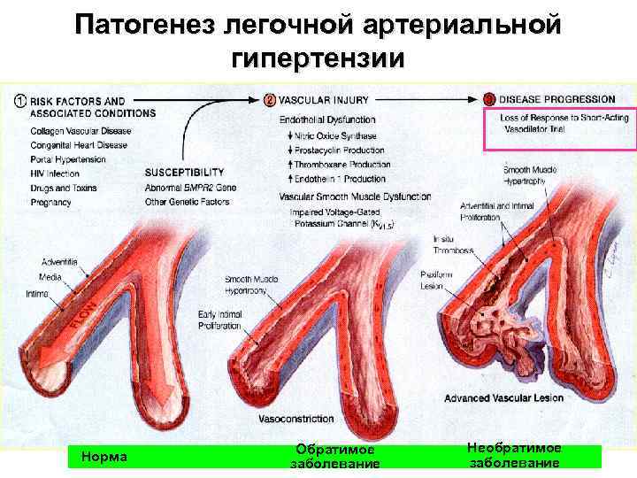 Патогенез легочной артериальной гипертензии Норма Обратимое заболевание Необратимое заболевание 
