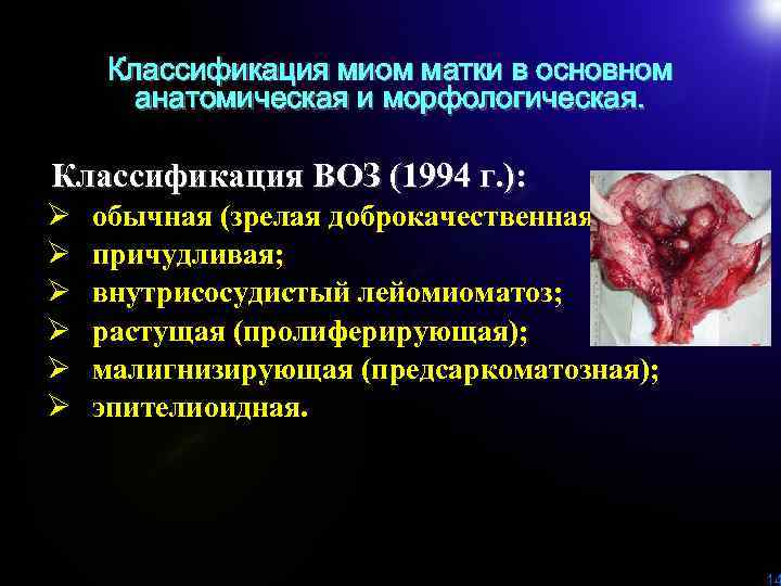 Классификация миом матки в основном анатомическая и морфологическая. Классификация ВОЗ (1994 г. ): Ø