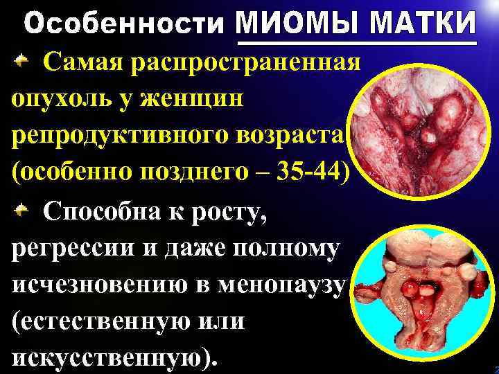 Самая распространенная опухоль у женщин репродуктивного возраста (особенно позднего – 35 -44) Способна к