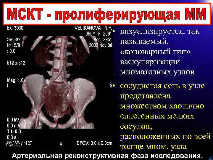  • визуализируется, так называемый, «коронарный тип» васкуляризации миоматозных узлов • сосудистая сеть в