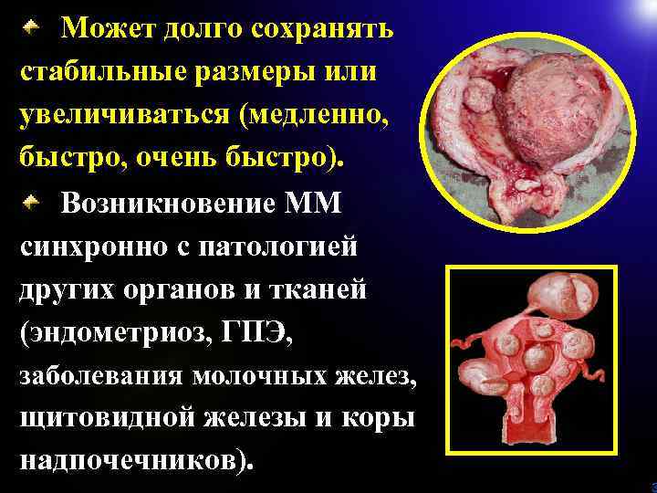 Может долго сохранять стабильные размеры или увеличиваться (медленно, быстро, очень быстро). Возникновение ММ синхронно