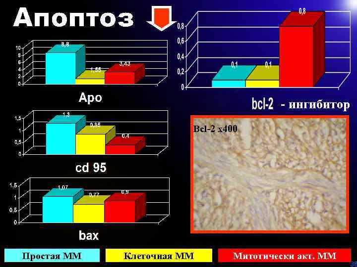 - ингибитор Bcl-2 х400 Рис. 6 Вcl-2 в клеточной миоме матки. Х 400 Простая
