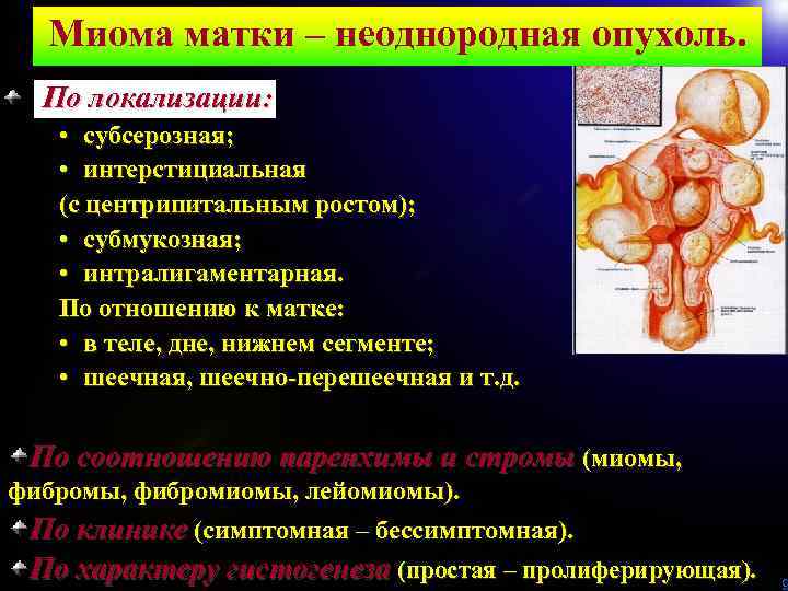 Миома матки – неоднородная опухоль. По локализации: • субсерозная; • интерстициальная (с центрипитальным ростом);