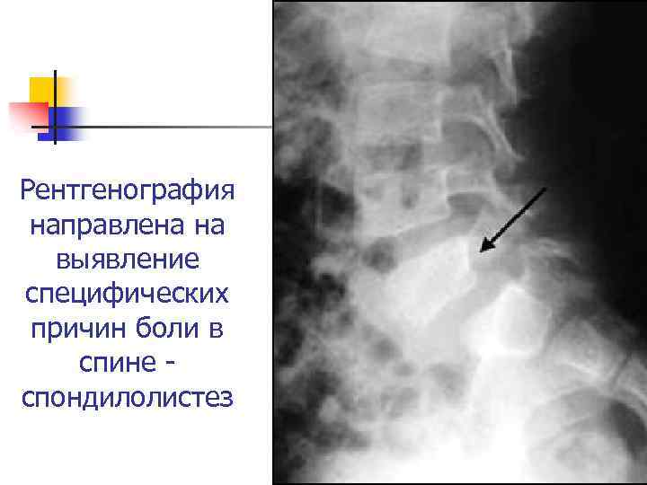 Рентгенография направлена на выявление специфических причин боли в спине спондилолистез 