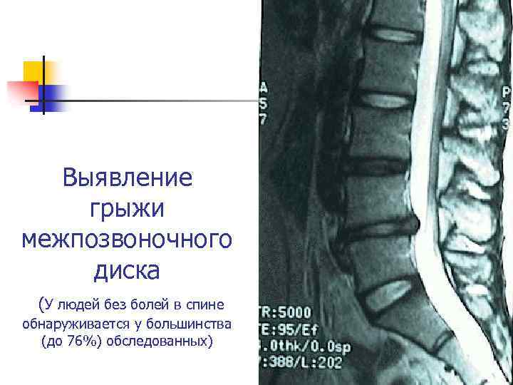 Выявление грыжи межпозвоночного диска (У людей без болей в спине обнаруживается у большинства (до