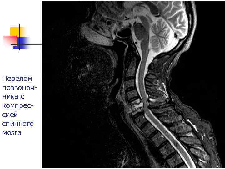 Перелом позвоночника с компрессией спинного мозга 