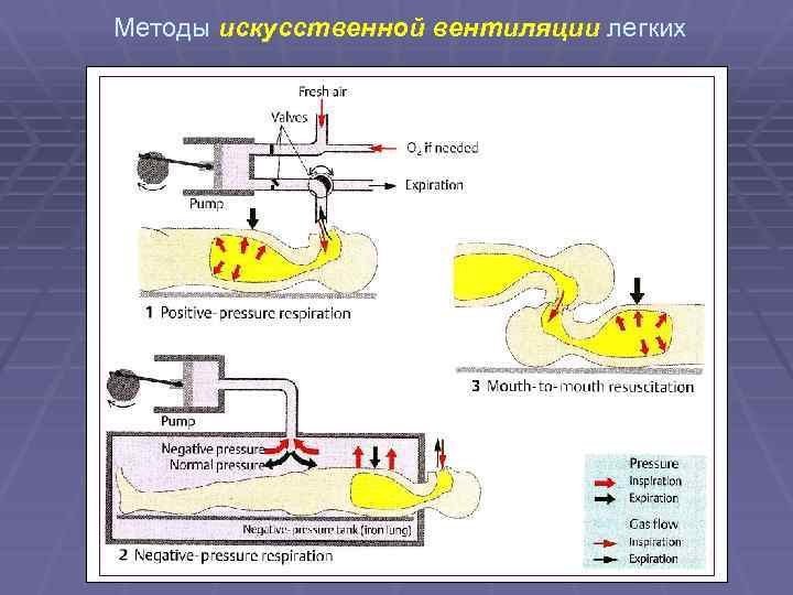 Произвести искусственную вентиляцию легких. Методы искусственной вентиляции. Методы искусственной вентиляции легких.