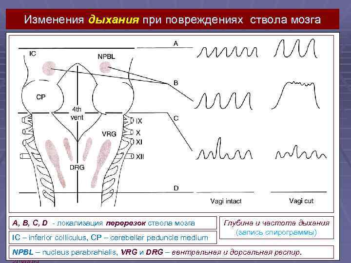 Изменения дыхания при повреждениях ствола мозга A, B, C, D - локализация перерезок ствола