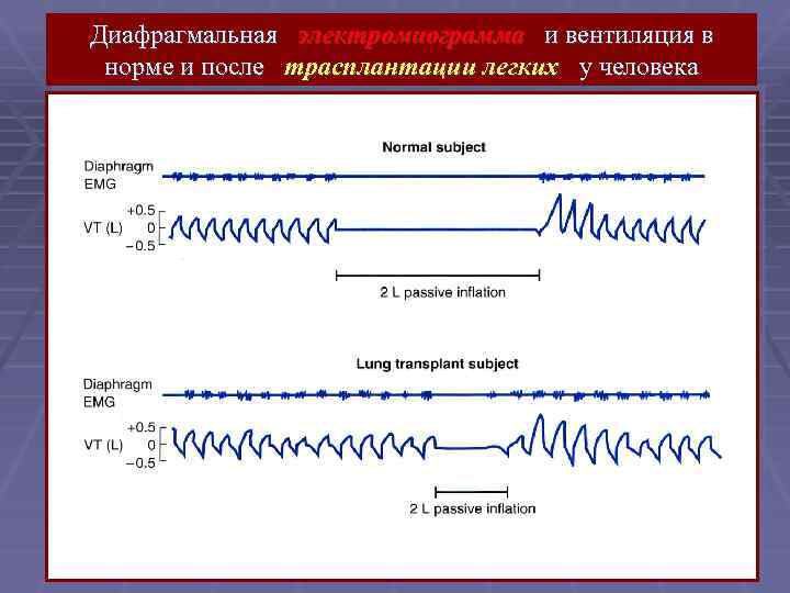 Диафрагмальная электромиограмма и вентиляция в норме и после трасплантации легких у человека 