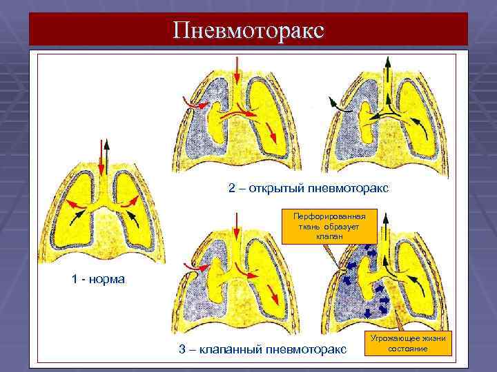 Что такое пневмоторакс. Открытый и клапанный пневмоторакс. Пневмоторакс открытый закрытый клапанный. Клапанный пневмоторакс.